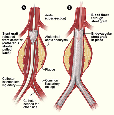 Aortic Aneurysm Endovascular Repair