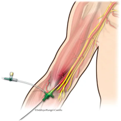 Brachial Artery Interventions