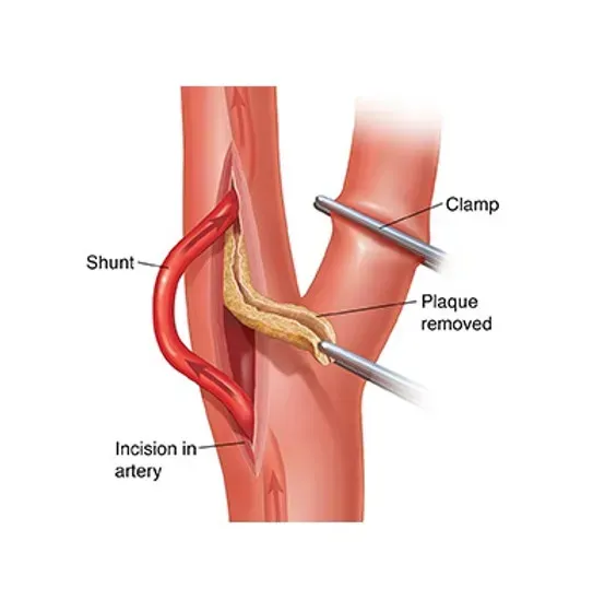 Carotid Interventions