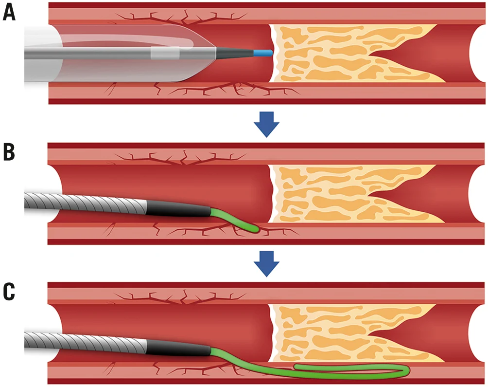 Chronic Total Occlusion (CTO)