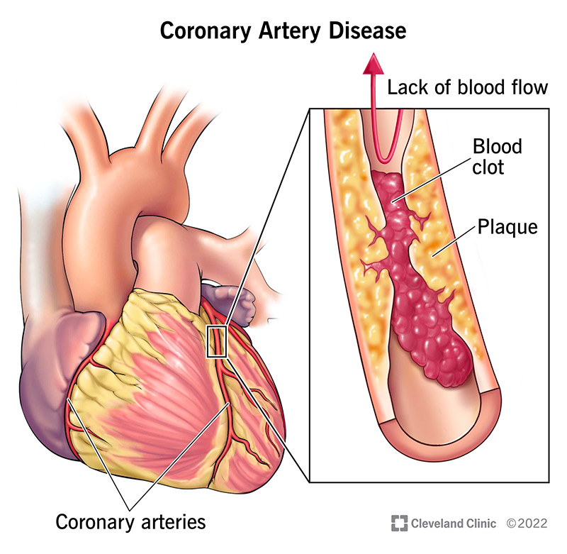 Coronary Artery Disease