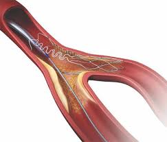Coronary Bifurcation Interventions