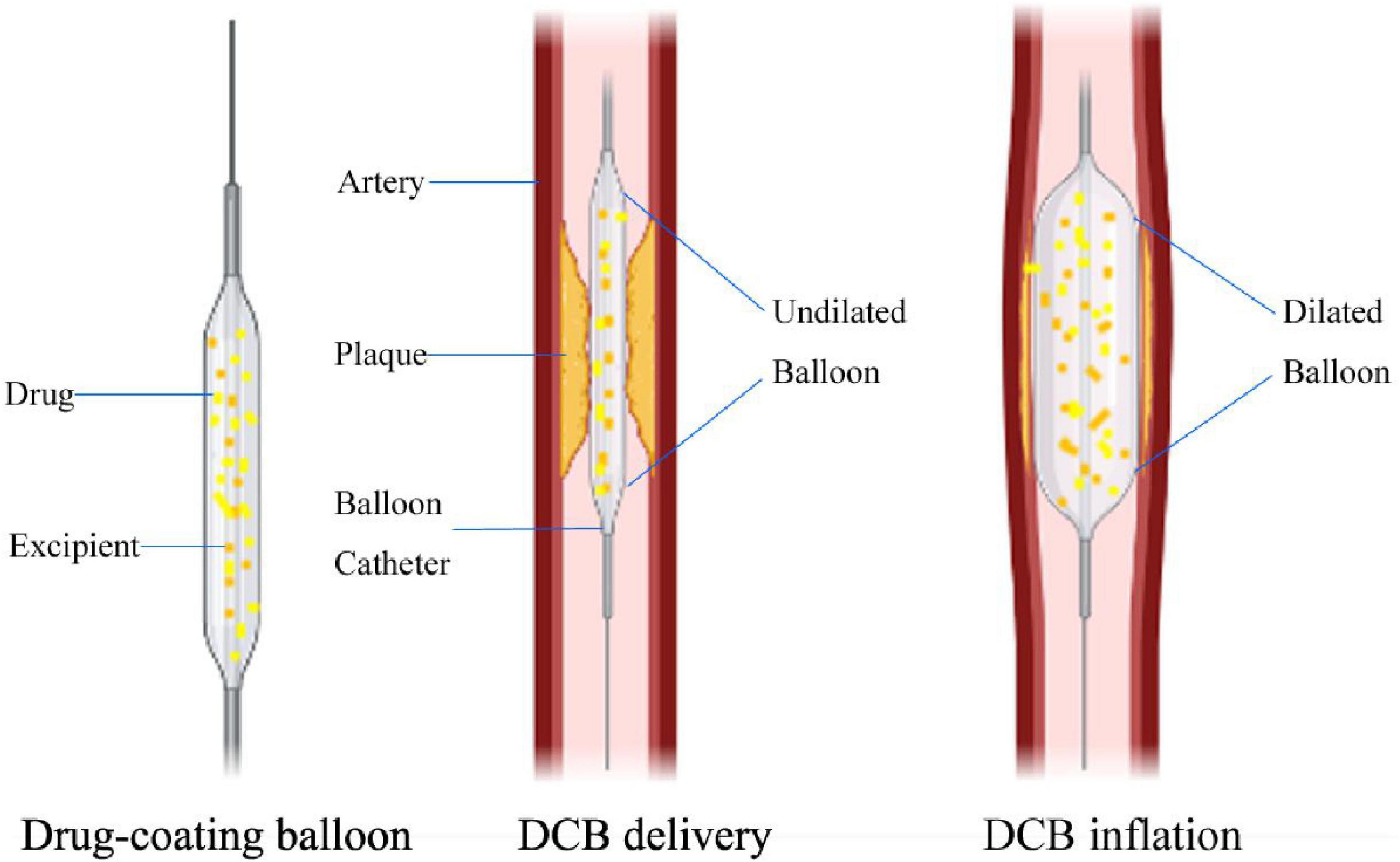 Drug-Coated Balloon Therapy