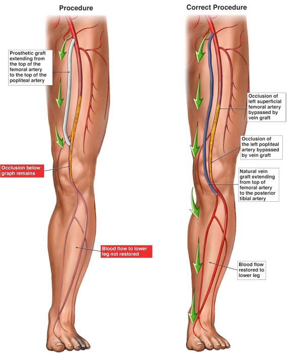 Lower Extremity Interventions