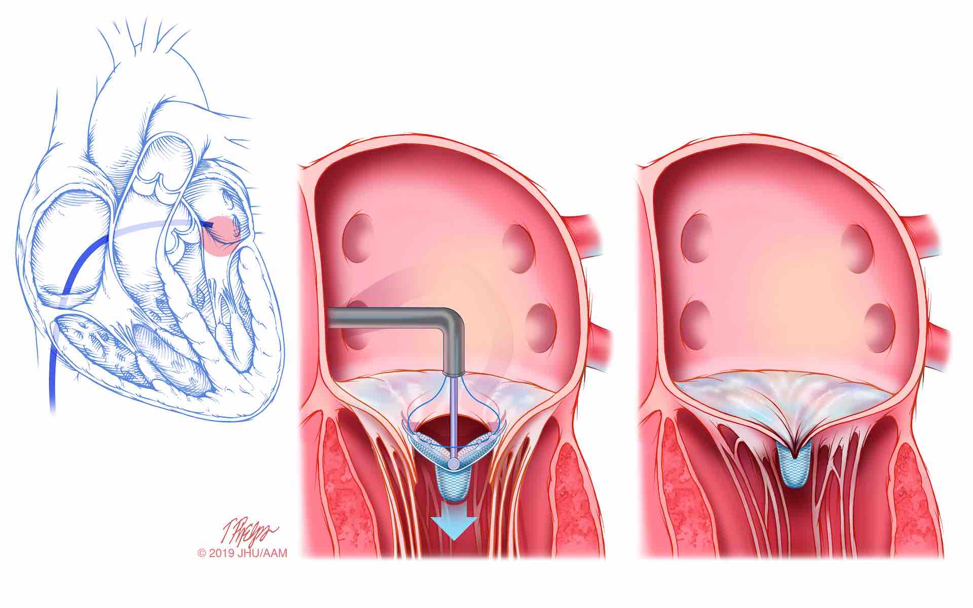 Mitral Valve Repair