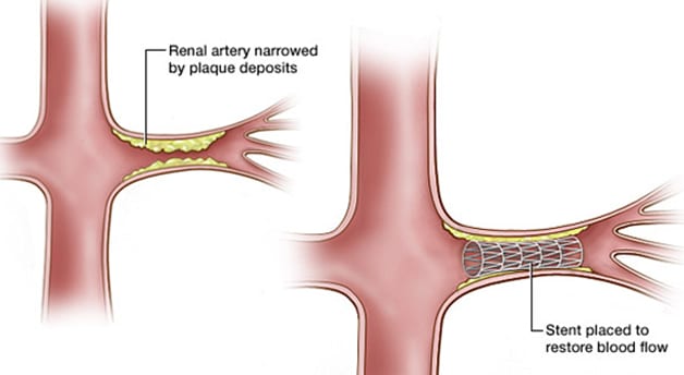 Renal Artery Interventions