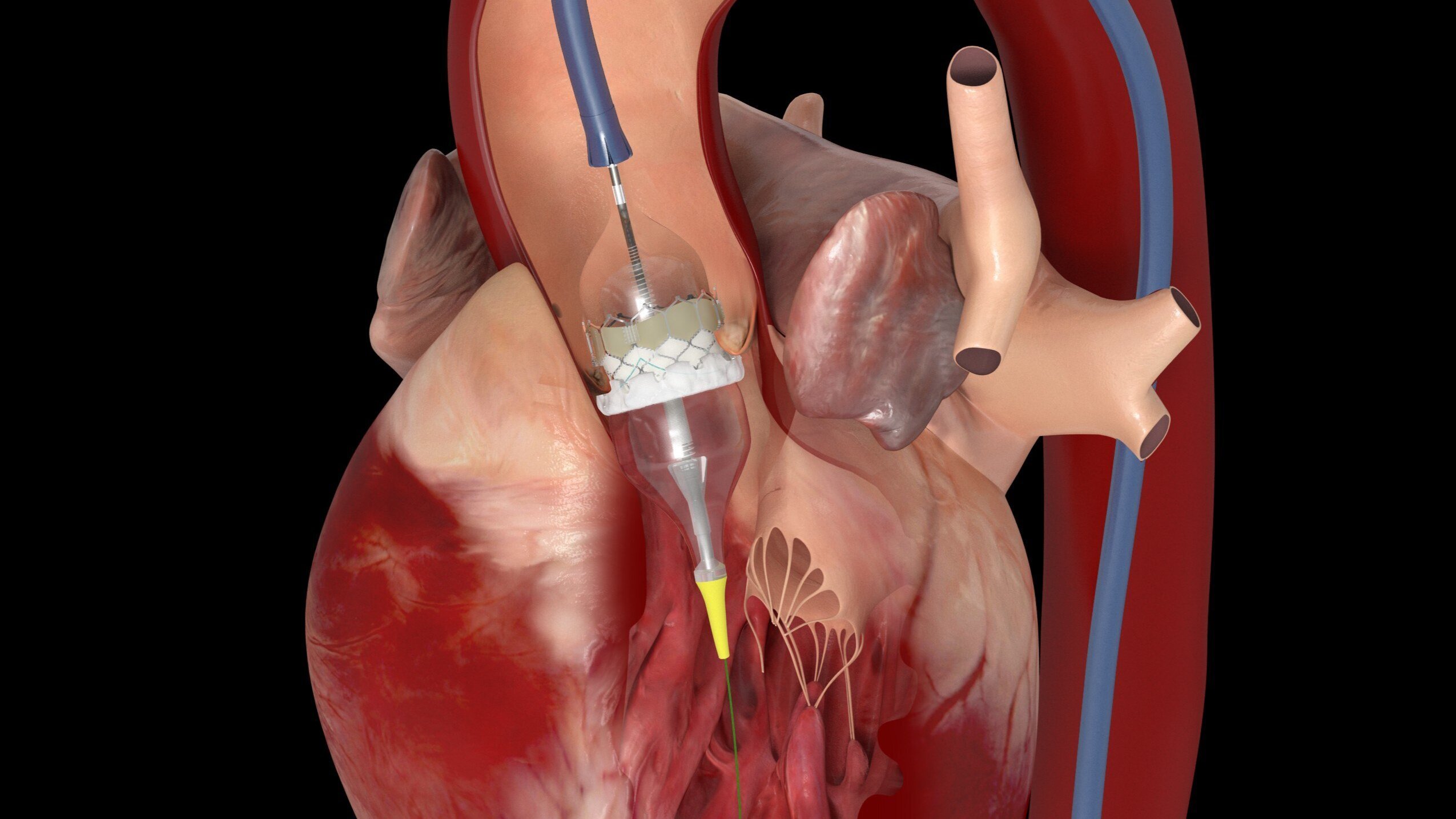 TAVI (Transcatheter Aortic Valve Implantation)