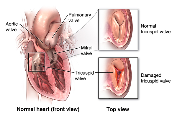 Tricuspid Valve Repair